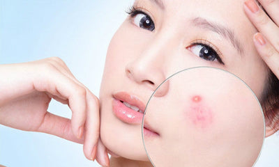 Có cần thiết phải sử dụng sữa rửa mặt cho da mụn riêng biệt?